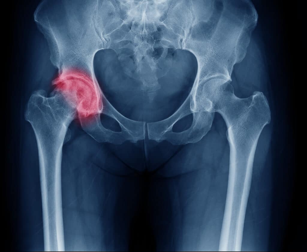 Osteoporosis-Related Risks