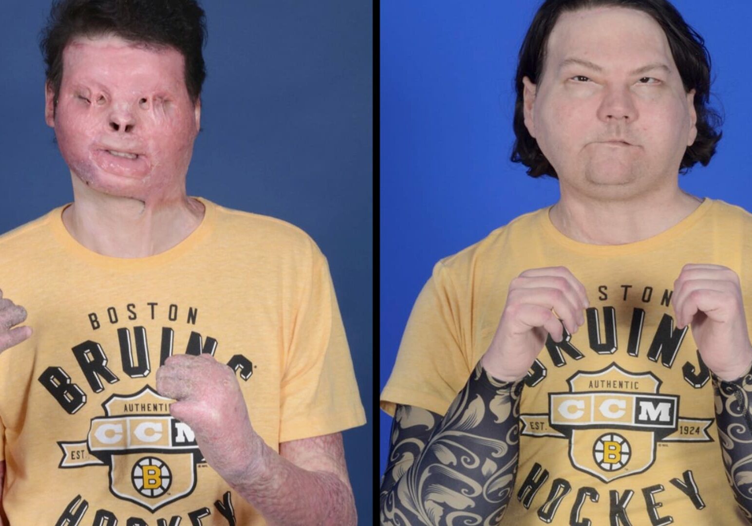 210203160206-joe-dimeo-face-hand-transplant-before-and-after