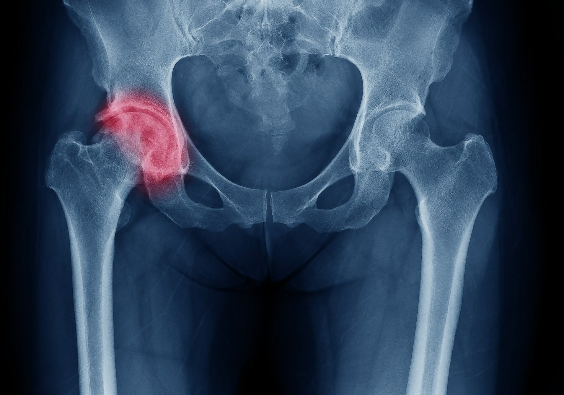 Osteoporosis-Related Risks